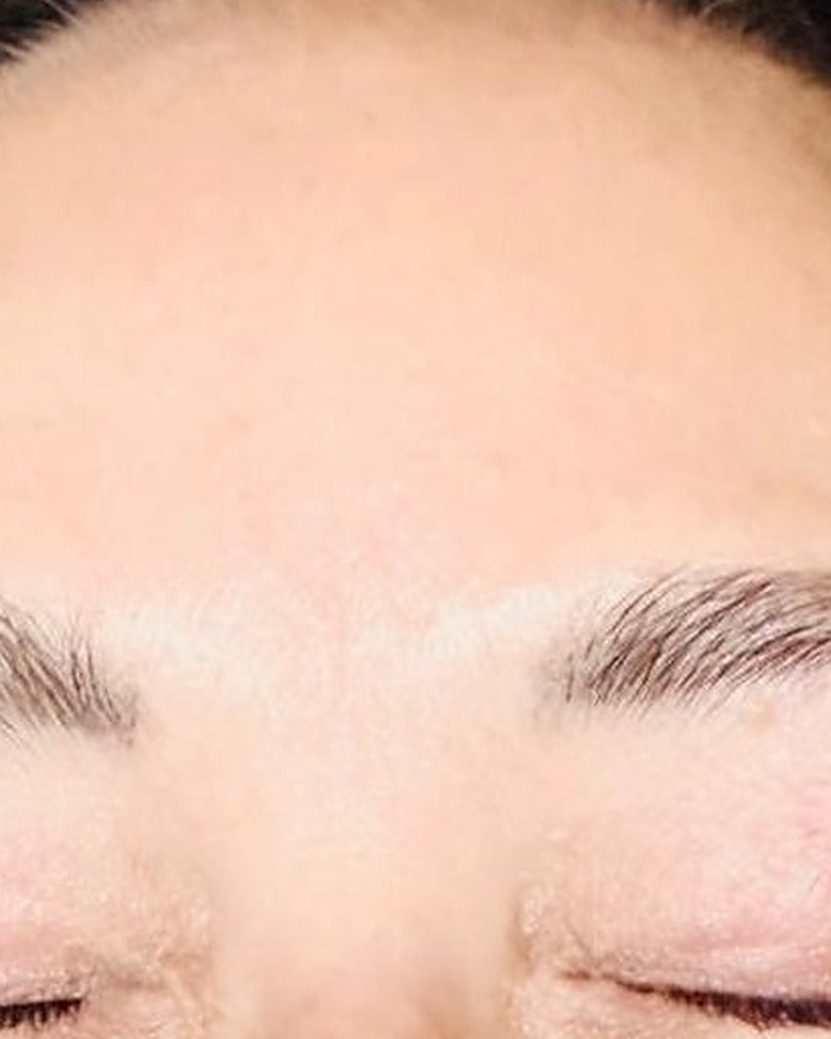 Before client's forehead, texture and clarity progress