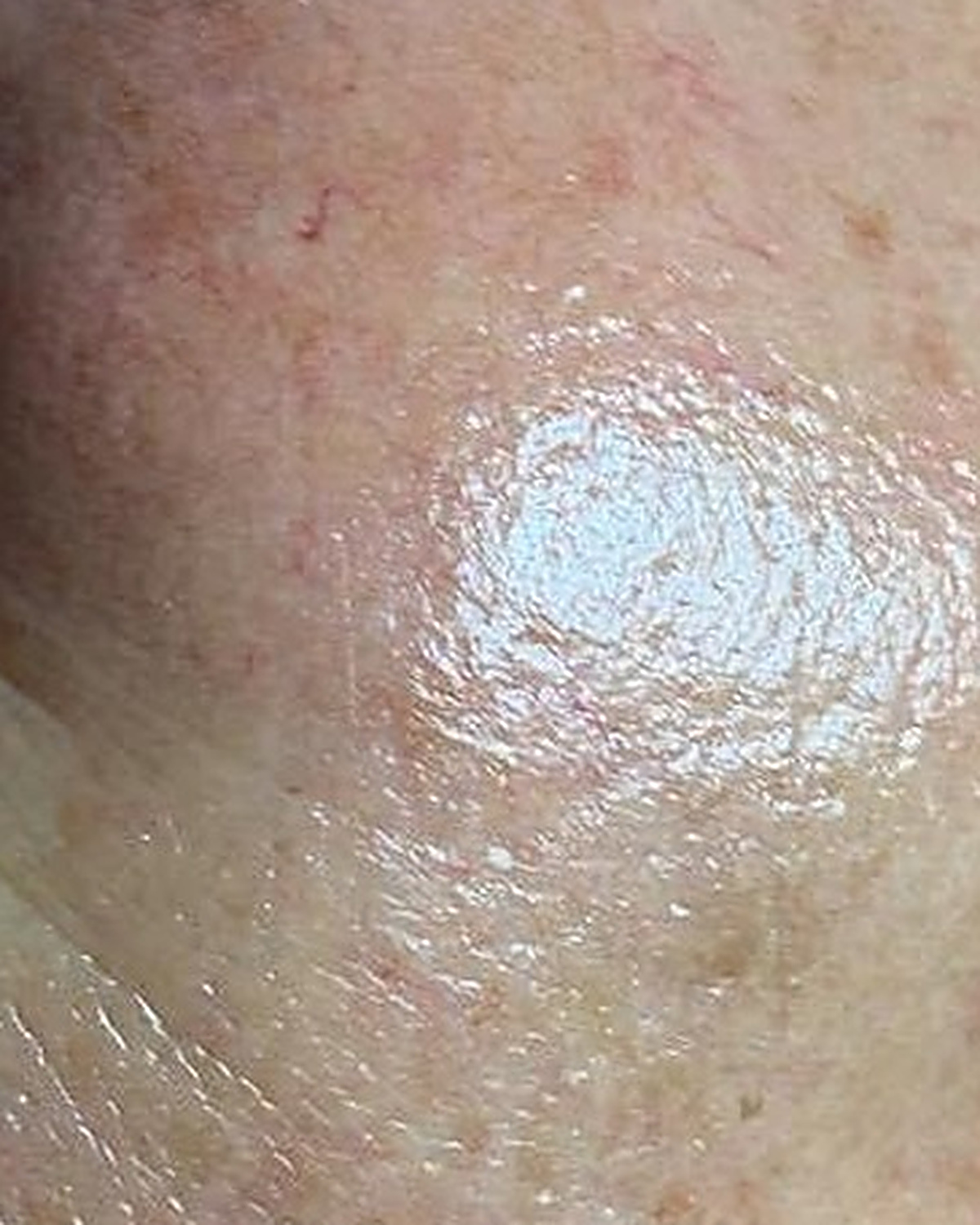 After client's cheek, hydration progress