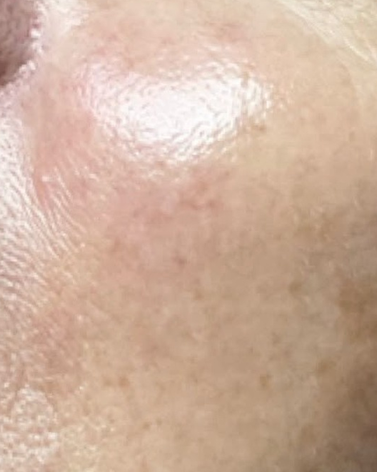 After client's cheek, tone and pigment progress
