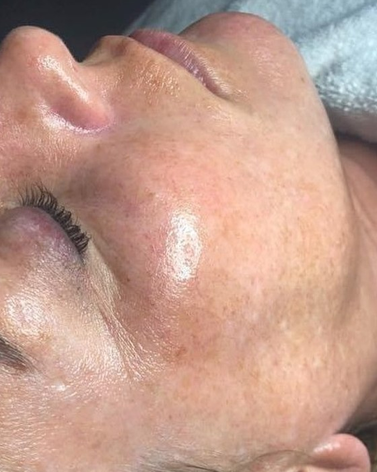 After client's cheek during a resurfacing series