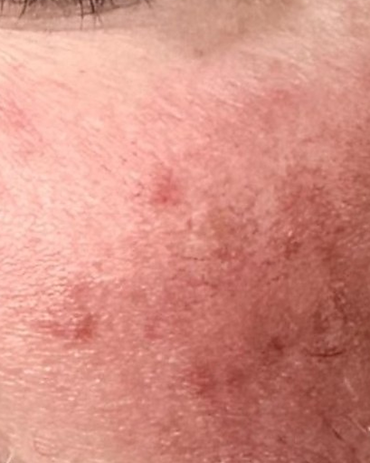 Before client's cheek, redness and sensitivity progress