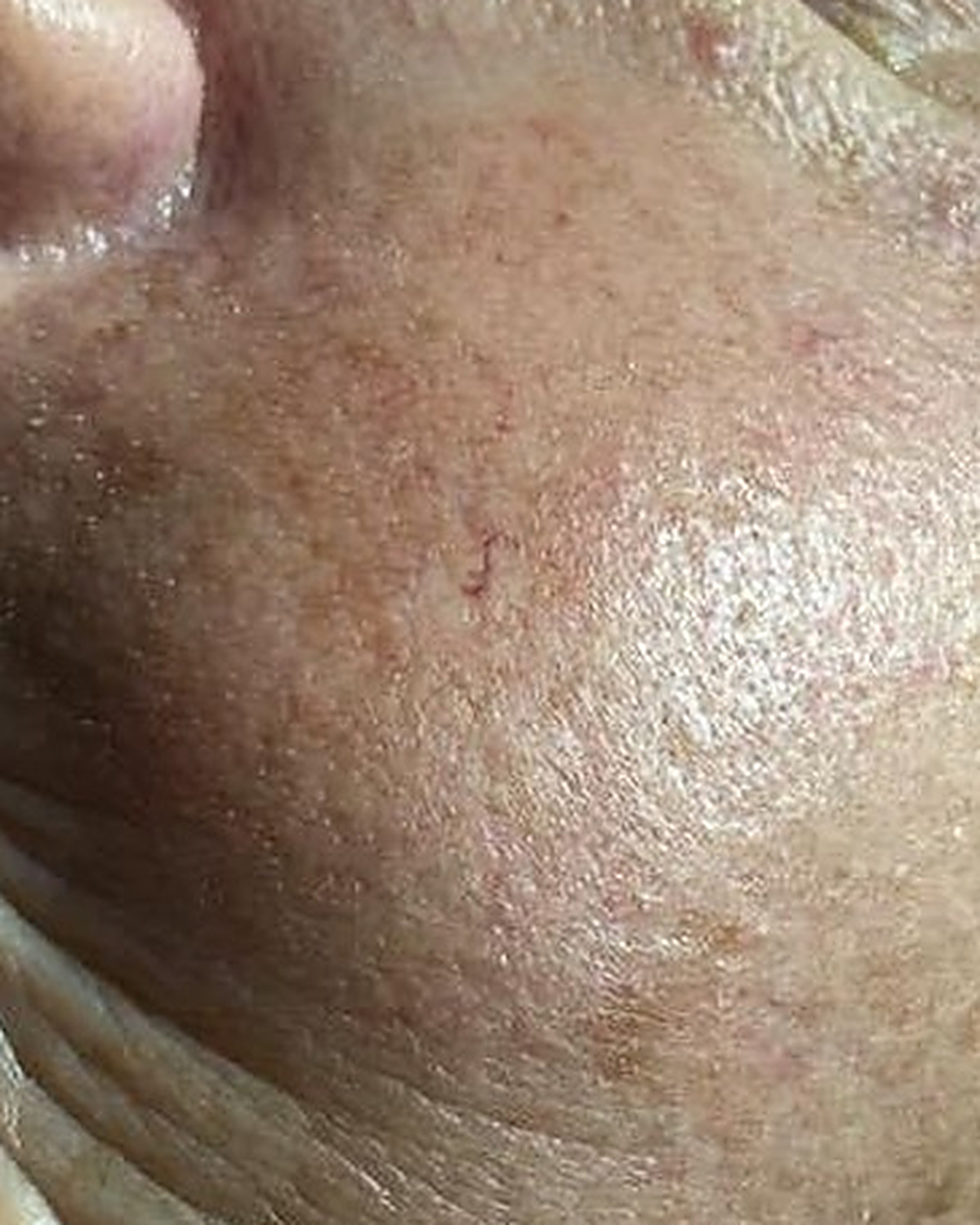 Before client's cheek, hydration progress