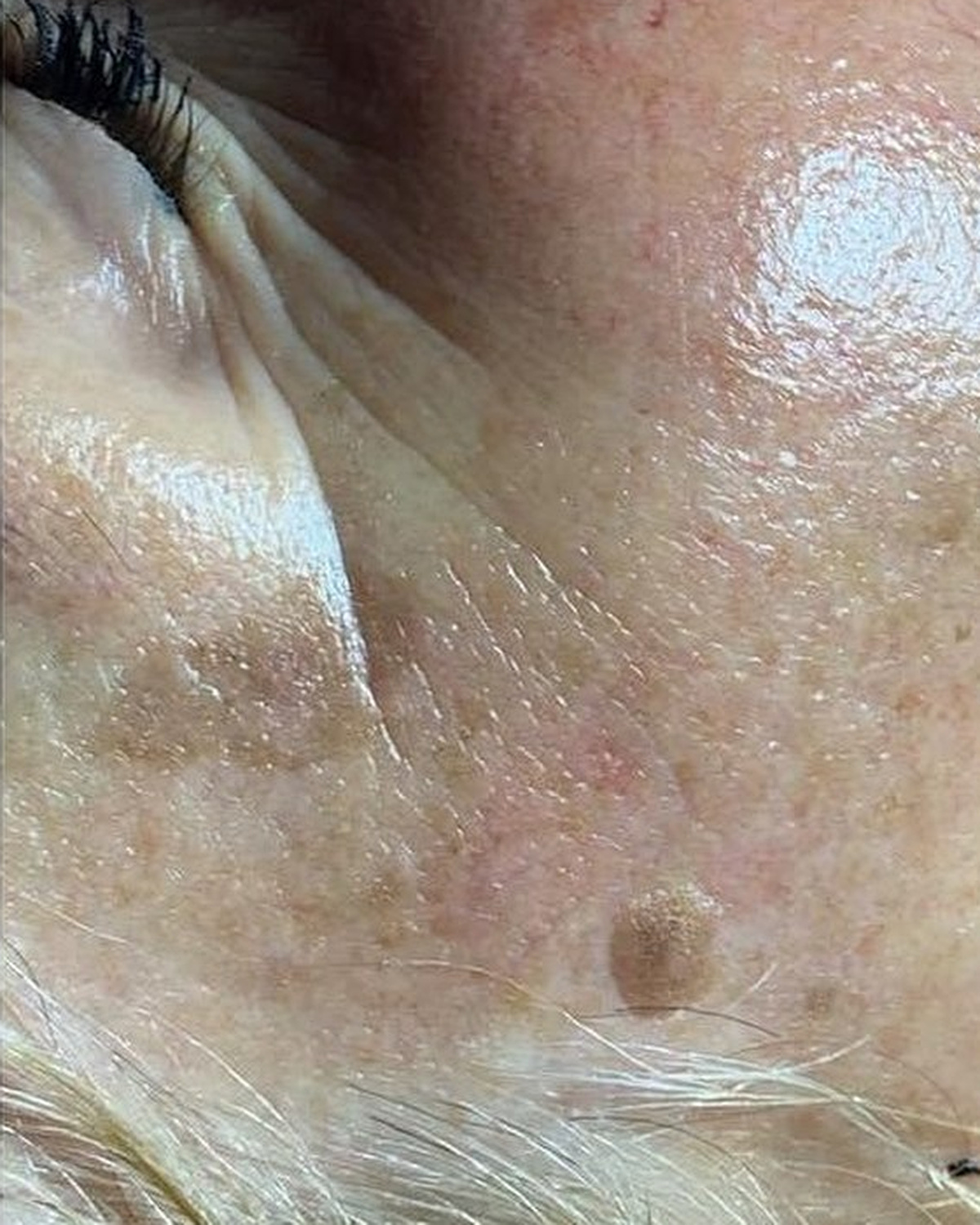 After client's eye area, firmness and fine line progress