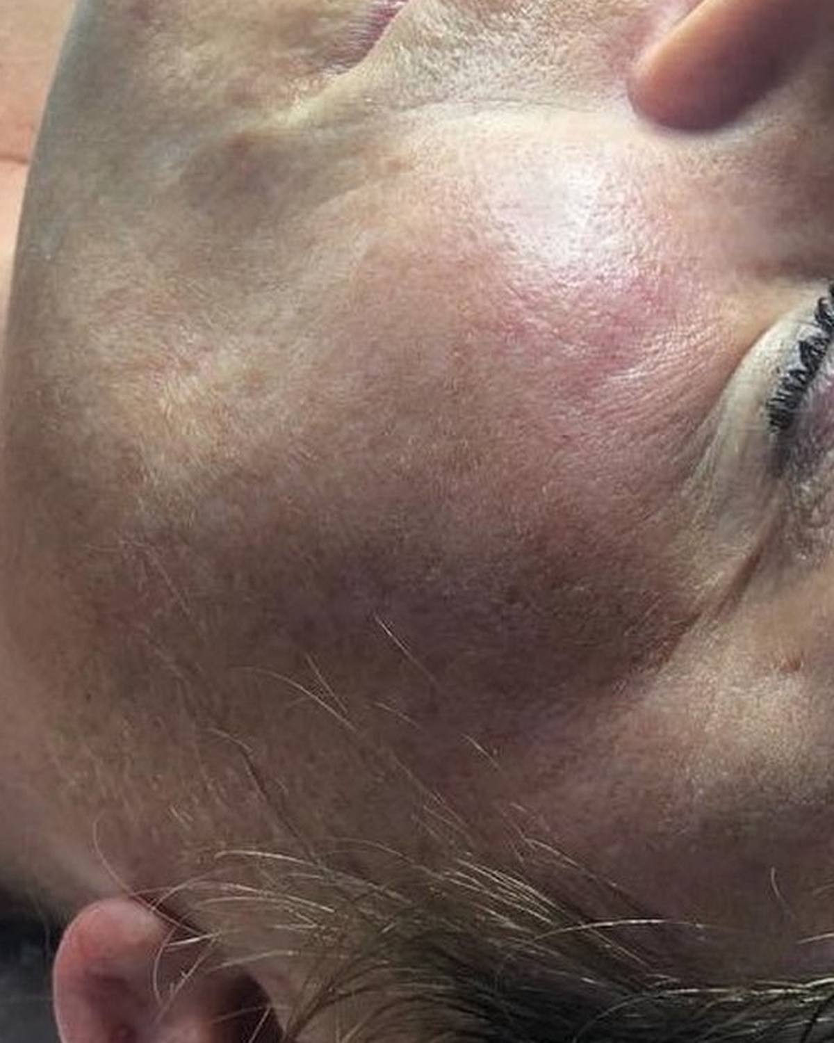 Before client's cheek during a resurfacing series