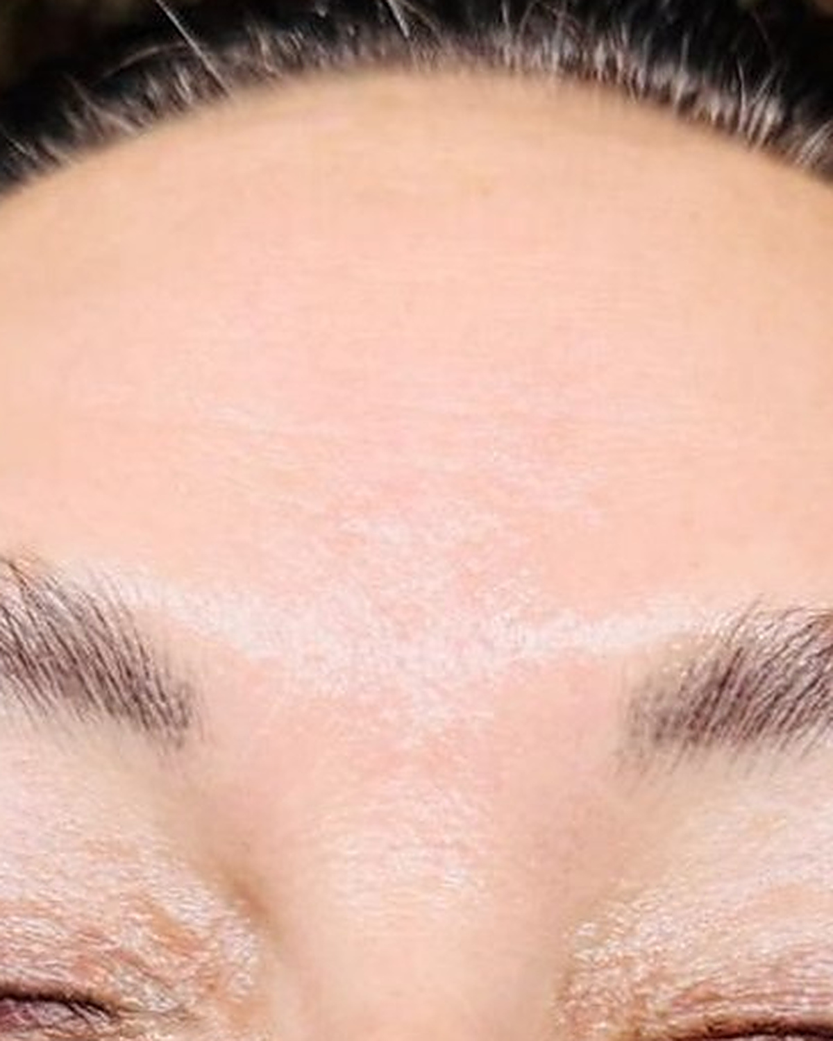 After client's forehead, texture and clarity progress